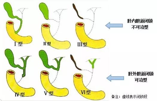 胆道闭锁的排除时间，深入了解与科学判断